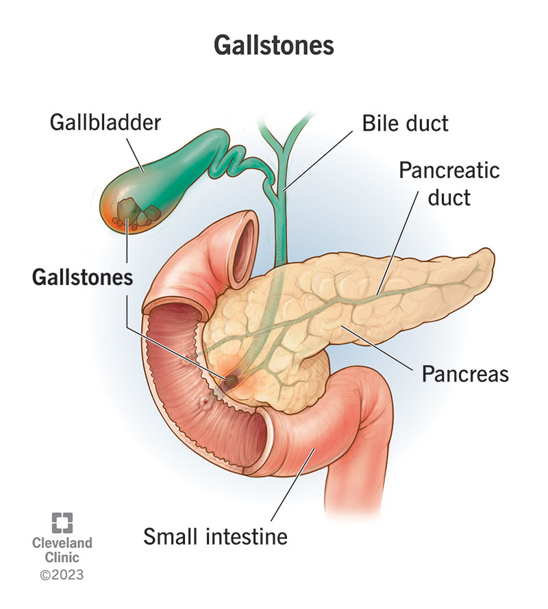 What Causes Gallstones? Symptoms, Risk Factors, Prevention, and What to Do Next